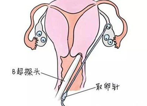 在杭州做试管婴儿的成功率是多少？了解一下有哪些试管婴儿医院。