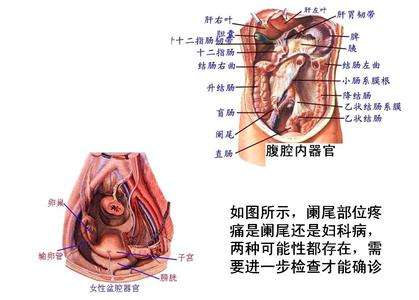 杭州试管婴儿技术可以解决阑尾炎引起的不孕不育问题
